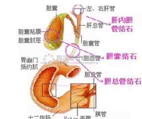 胆囊结石怎么形成原因 胆襄结石是怎样形成的？