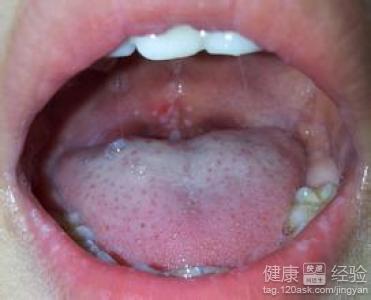 小孩手足口病吃什么药 轻微手足口吃什么药?