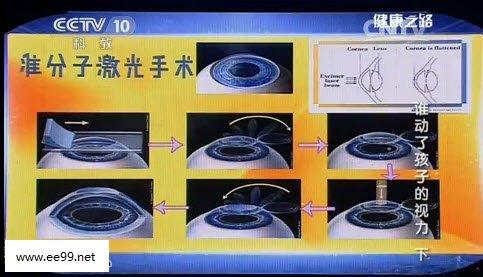 张振贤 20160114X诊所视频和笔记:张振贤,用眼过度,近视眼,青光眼,白内障