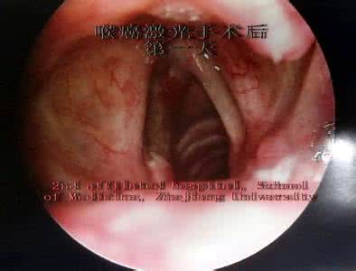 喉癌手术后能说话吗 喉癌手术后，是不是不能说话了？