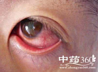 眼睛红血丝是怎么回事 眼睛红血丝 眼睛红血丝污秽了你的美 是怎么回事