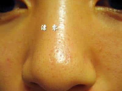 鼻子毛孔粗大黑头多 鼻子毛孔粗大、黑头怎么办