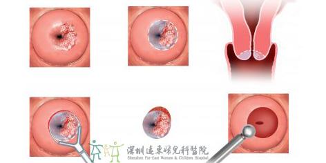 怎么预防宫颈糜烂 宫颈糜烂是怎么引起的 了解5个因素预防有道