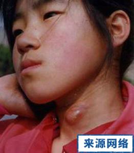 颈部淋巴结核的症状 颈淋巴结核 颈淋巴结核的症状