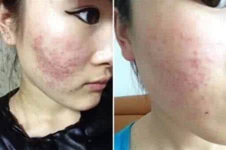 治疗脸上痘痘和痘印 痘痘痘印怎么治疗 长痘痘了可以治啊 长痘印了可就麻烦了！