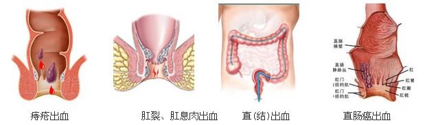 肛门疼痛便血 肛门疼痛便血 便血肛门痛怎么回事？