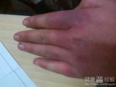 冻疮的症状 冻疮的症状 冻疮的原因及症状