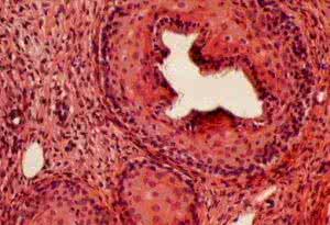 接触性出血 接触性出血 正确了解接触性出血问题