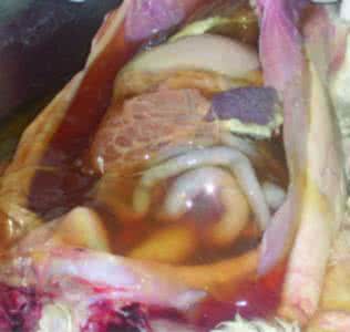 腹膜炎的症状及治疗 腹膜炎症状 治疗腹膜炎的方法有哪些