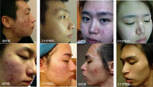 严重痤疮的治疗方法 痤疮的治疗方法是有哪些 患者可以多吃什么