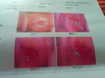 二度宫颈糜烂怎么治好 二度宫颈糜烂怎么治比较好？