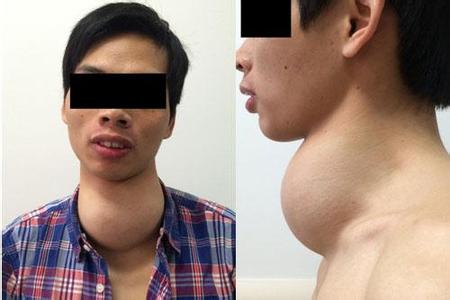 甲状腺肿瘤 (1)甲状腺肿瘤