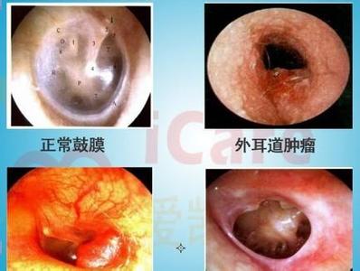 鼓膜穿孔会聋吗 鼓膜破了会聋吗?