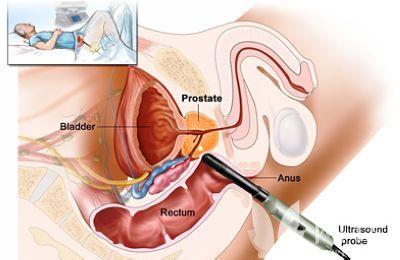 前列腺癌的早期症状 前列腺癌症状 了解前列腺癌症状正确治疗