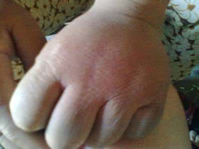 血管神经性水肿 血管神经性水肿 血管神经性水肿会痛吗？