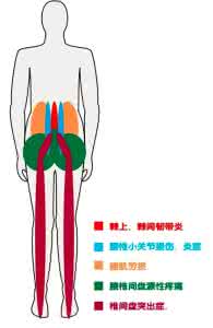 腰疼的治疗方法 腰疼的治疗方法 腰疼的自我诊断+治疗