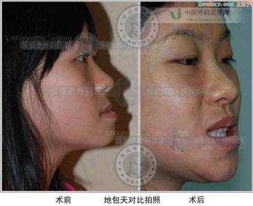 乳牙地包天怎么办 乳牙地包天怎么办 乳牙地包天怎样治疗才好