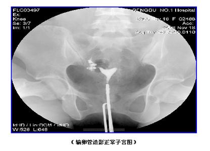 输卵管造影影响怀孕吗 怀孕前输卵管造影吗？