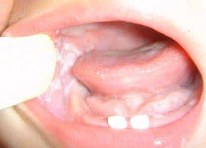 小儿鹅口疮怎么治疗 川黄粉治小儿鹅口疮