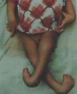 多巴反应性肌张力障碍 多巴反应性肌张力障碍 它有什么症状