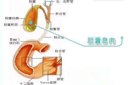 胆囊息肉的症状及治疗 胆囊息肉的高发人群 胆囊息肉的治疗