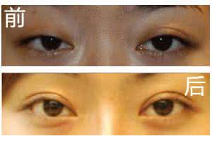 上睑下垂手术多少钱 上睑下垂多少钱 你对上睑下垂了解多少？