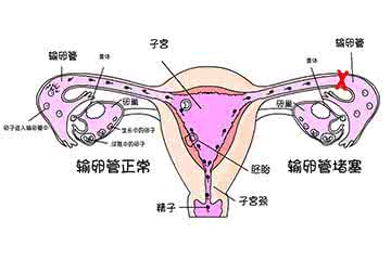 输卵管堵塞常见的症状 输卵管堵塞常见的症状 输卵管堵塞的常见因素