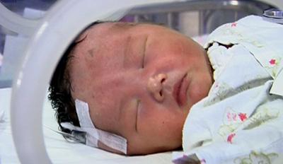 新生儿溶血症检查 新生儿溶血什么时候查 新生儿溶血症检查