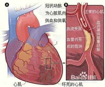 心肌梗塞几分钟就死了 心肌梗塞几分钟就死了 突发心肌梗塞怎么办