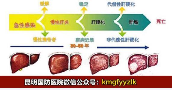 肝癌晚期治疗方法 肝癌方三