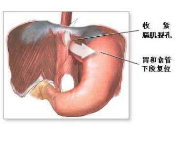 食管裂孔疝 食管裂孔疝的鉴别 8种疾病与食管裂孔疝的区别