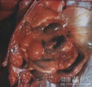 甲减的最典型症状表现 矽肺病的症状 这些表现最典型