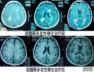 脑白质脱髓鞘原因 脑白质脱髓鞘原因 脑白质脱髓鞘 它的发病原因是什么