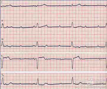 小儿窦性心动过缓 窦性心动过缓什么原因 小儿窦性心动过缓的原因