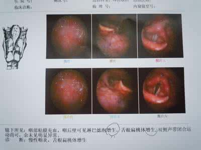 嗓子觉得有异物 慢性咽炎的方子 慢性咽炎，老觉得嗓子里有异物，1张汉代老方子常见效