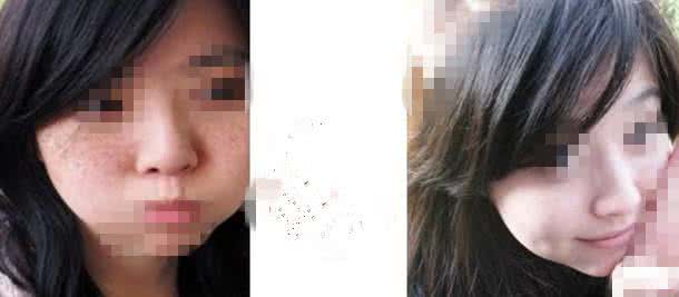 做激光美白效果好不好 激光美白效果怎样 激光美白的效果真的好吗