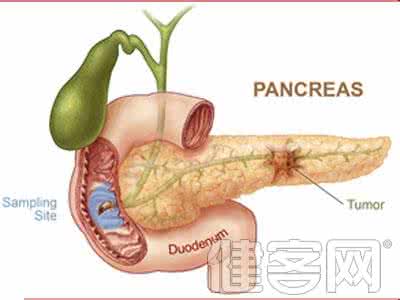 胰腺肿瘤如何治疗 胰腺肿瘤 如何治疗胰腺肿瘤