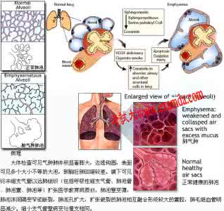 肺气肿的临床表现 肺气肿临床表现 肺气肿是怎么回事 肺气肿有哪些临床表现