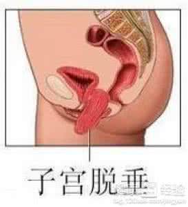 如何治疗子宫脱垂 子宫脱垂 如何治疗子宫脱垂