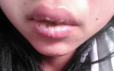 嘴唇起泡 嘴唇起泡 冬天一种食物让你嘴唇不起泡