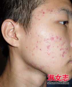 鼻子长痘痘怎么消除 鼻子长痘痘怎么消除 鼻子长痘痘怎么办