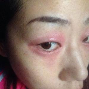 眼睛周围肿胀发红发痒 眼睛又痒又红又肿怎么办呢