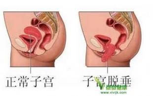 前壁脱垂能自己恢复吗 产后阴道前壁脱垂 预防阴道壁脱垂的方法