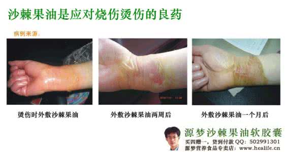 沙棘 烫伤 沙棘对烧伤、烫伤的惊人效果！所有的皮肤问题，包括牛皮癣，褥疮，烂疮，溃疡等，沙棘都可以解决！！