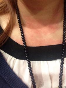 皮肤过敏能吃鱼吗 吃鱼皮肤过敏怎么办 皮肤过敏有什么护理方法