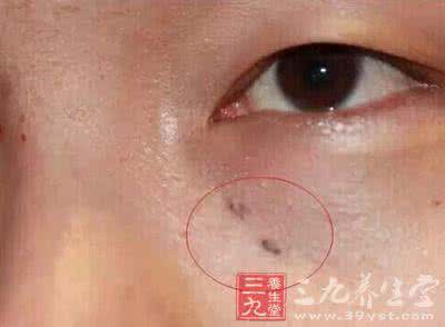 男子搓破一颗痣患癌症 脸上小小一颗痣 一查居然是癌