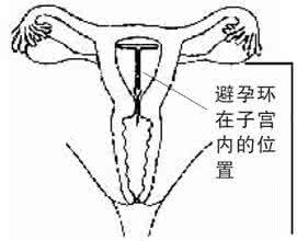 绝经后取节育环疼痛吗 绝经后取节育环疼痛吗 绝经后仍留节育环有风险