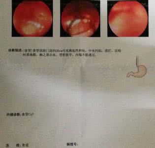 单一治疗食道癌秘方 食道癌（秘方数：13）