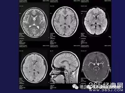 ct与mri融合标准 ct mri 图文 | 掌握CT、MRI还不是分分钟的事吗？