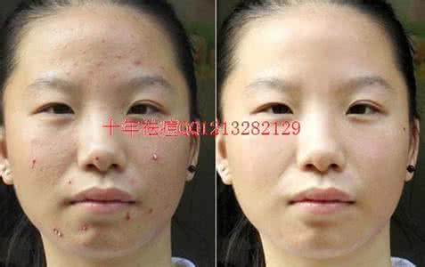 治疗青春痘的民间偏方 治疗青春痘的民间偏方 治疗青春痘几个偏方